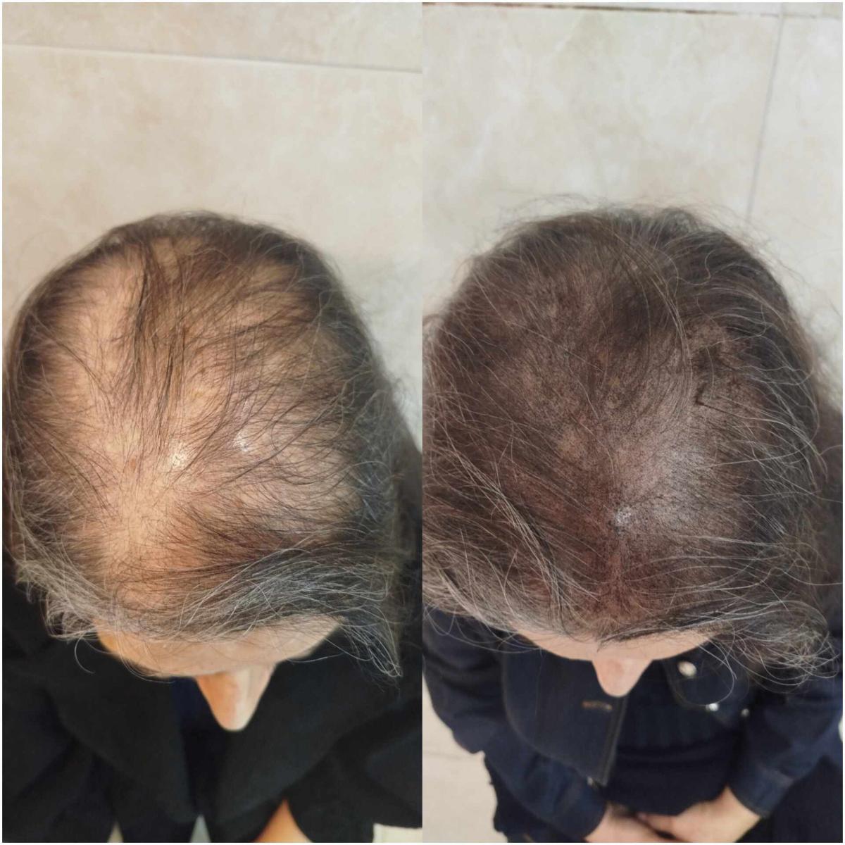 اسکالپ پوششی اسکالپ پوششی