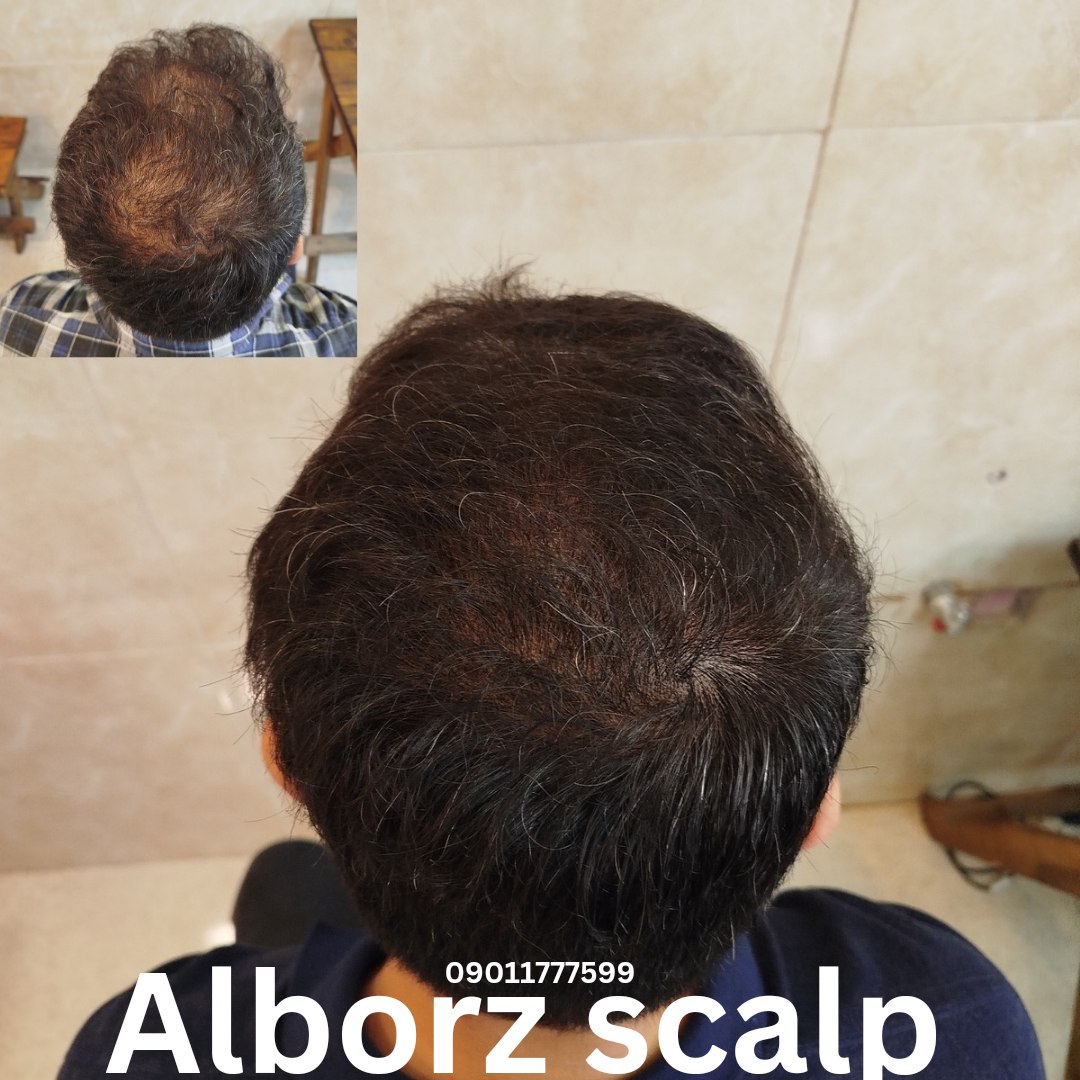 اسکالپ پوششی