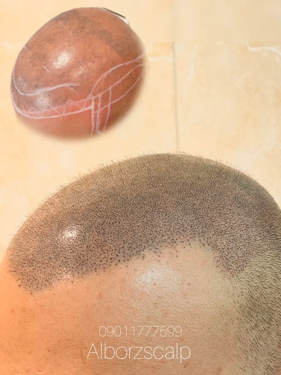 نمونه میکرواسکالپ