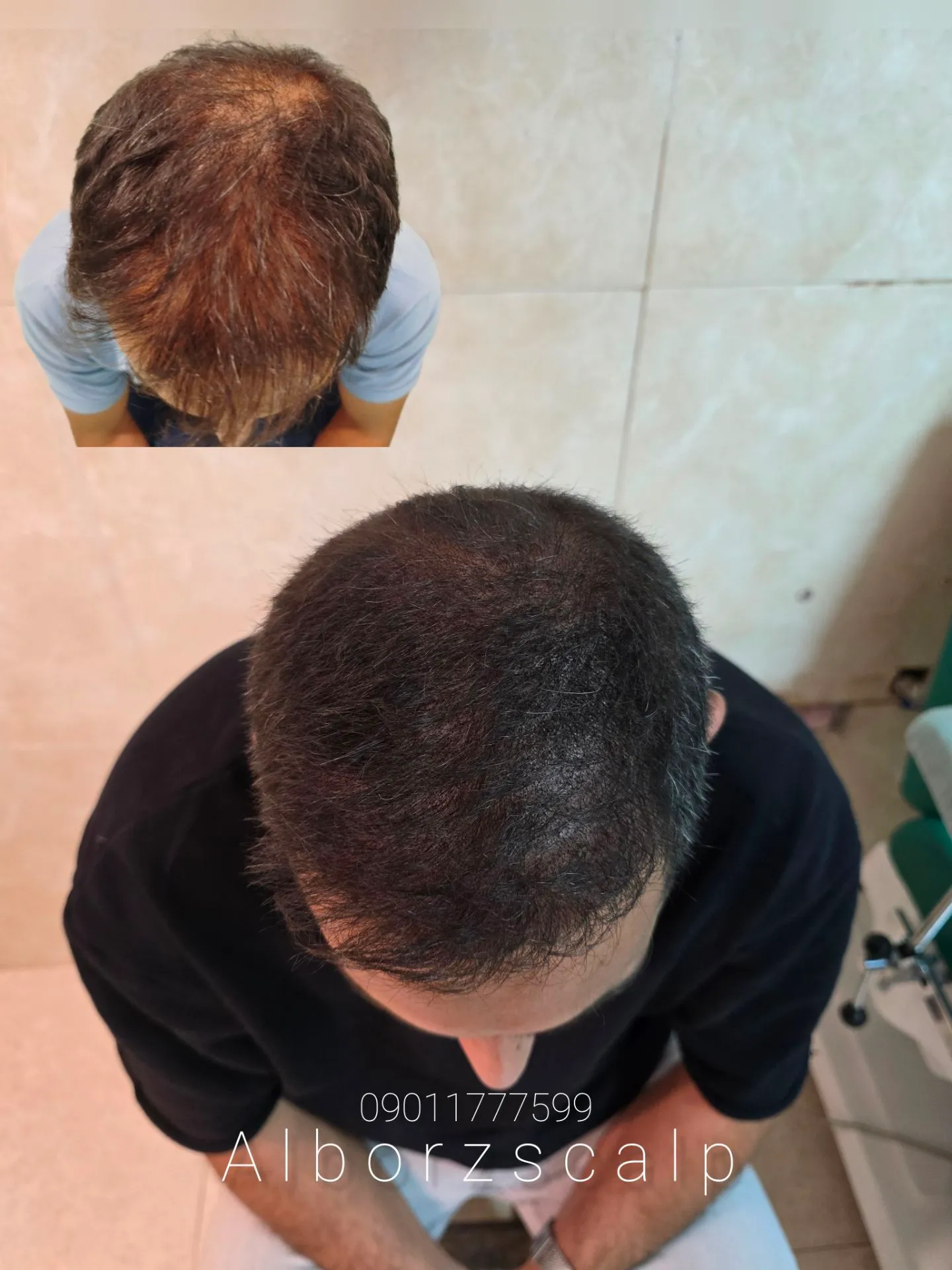 نمونه میکرواسکالپ