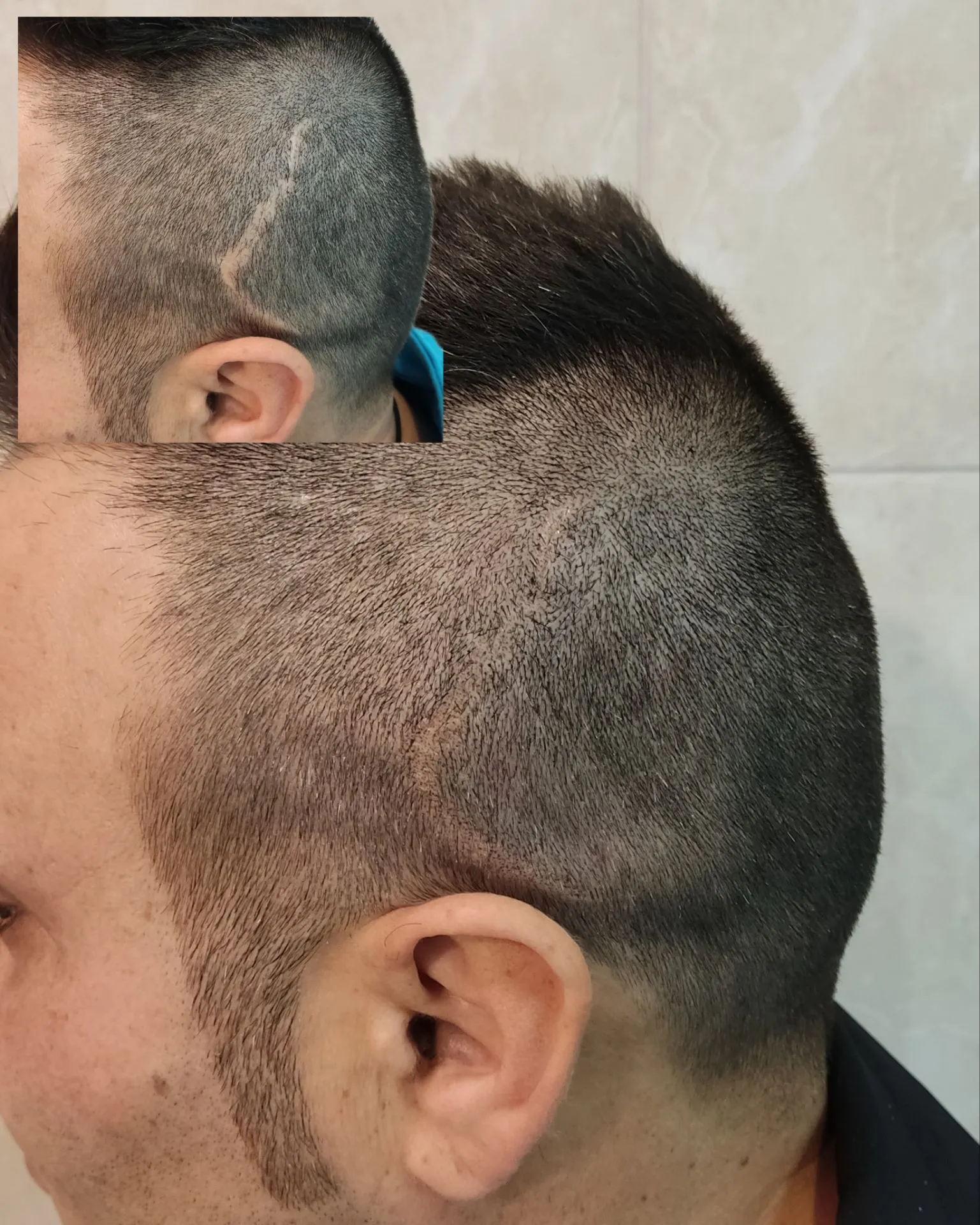 نمونه میکرواسکالپ