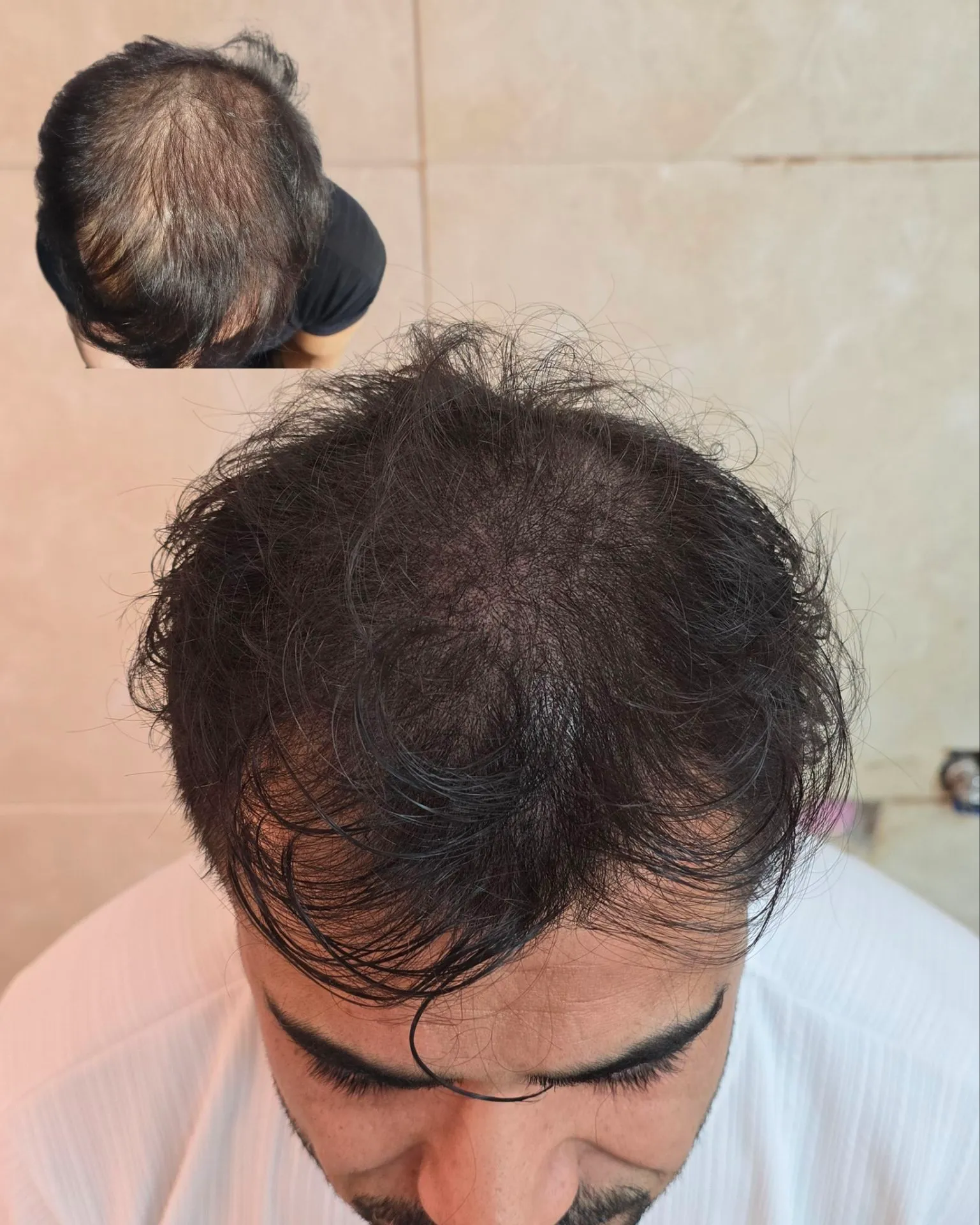 نمونه میکرواسکالپ